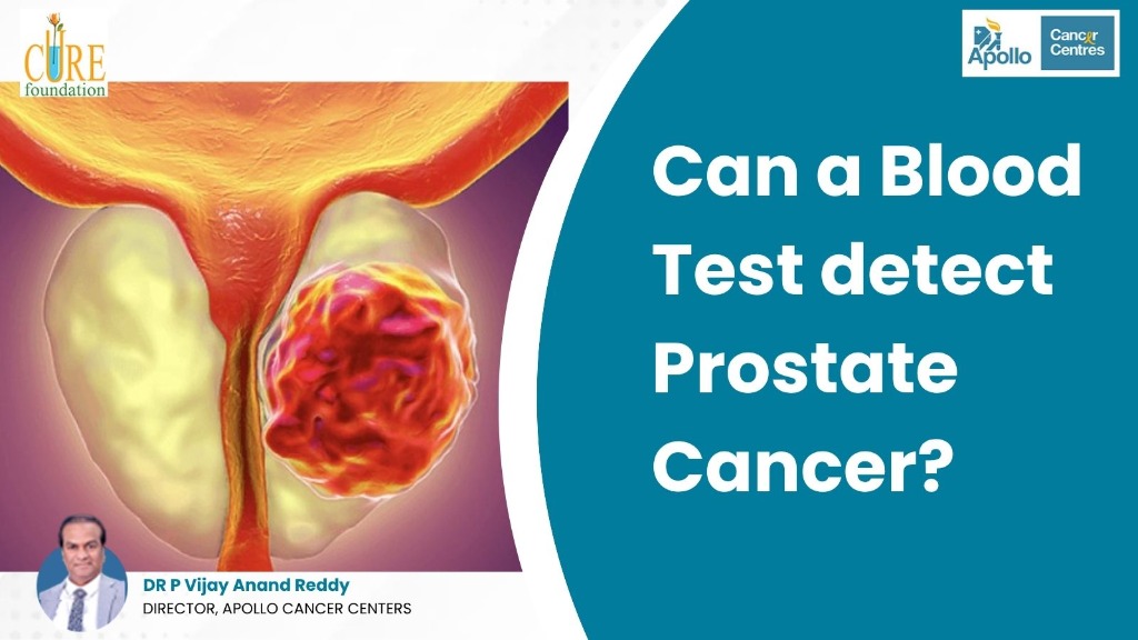 Can a Blood Test Detect Prostate Cancer?