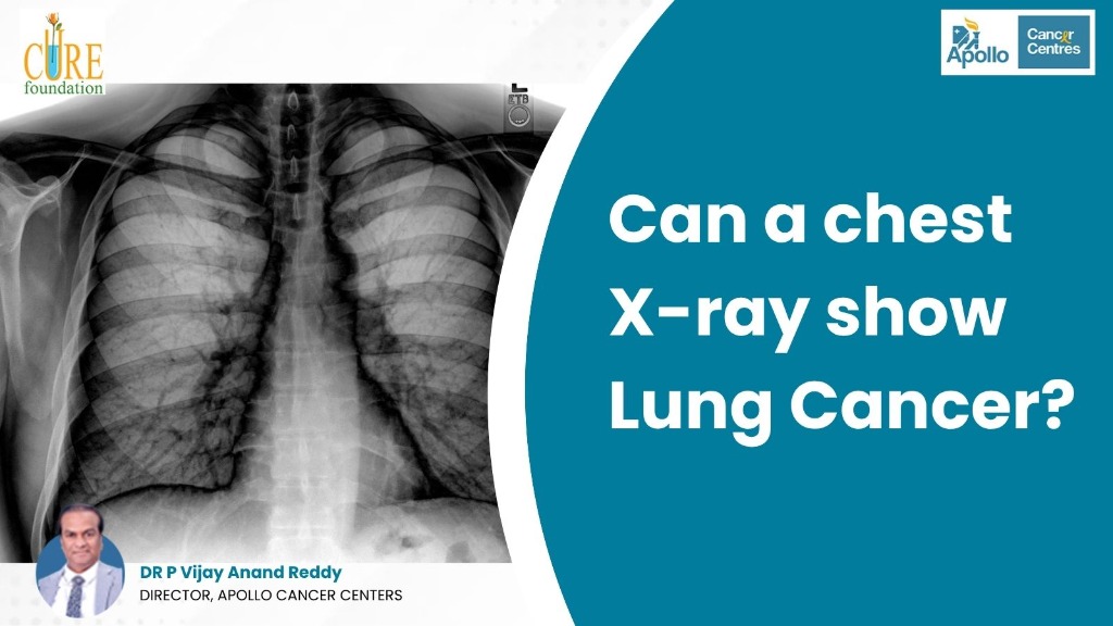 Can a chest X-ray show Lung Cancer?