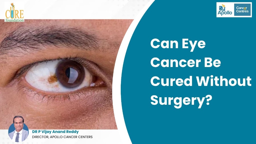 Can Eye Cancer Be Cured Without Surgery?