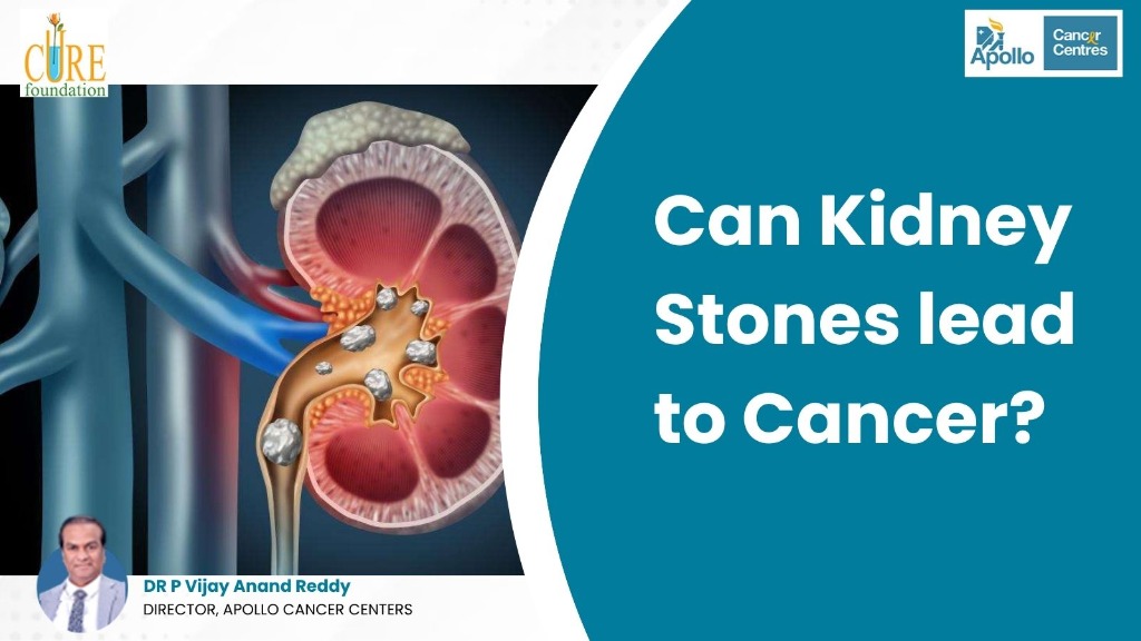 Can Kidney Stones lead to Cancer?