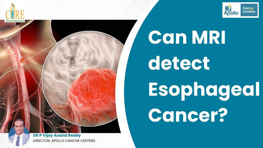 Can MRI detect Esophageal Cancer?