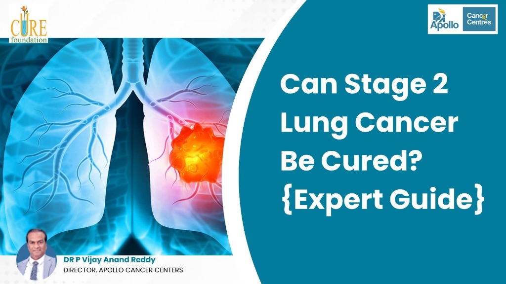 Can Stage 2 Lung Cancer Be Cured? {Expert Guide}