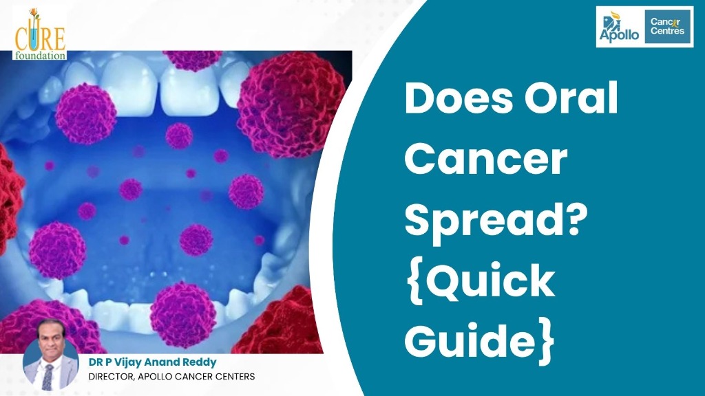 Does Oral Cancer Spread? {Quick Guide}
