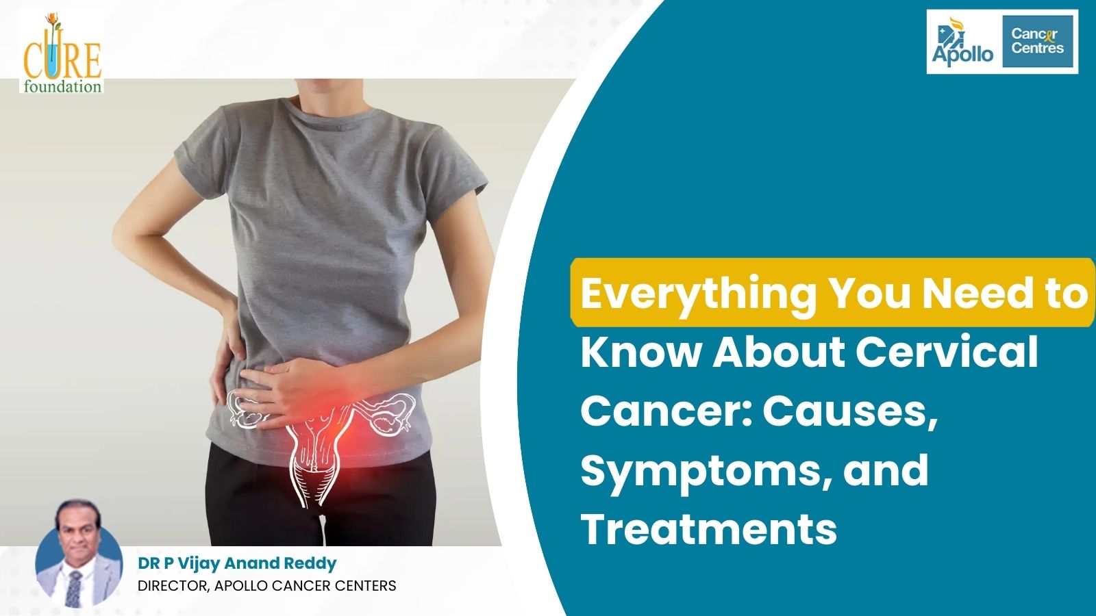 Everything You Need to Know About Cervical Cancer: Causes, Symptoms, and Treatments