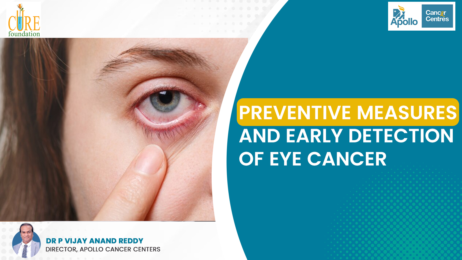 Preventive Measures and Early Detection of Eye Cancer