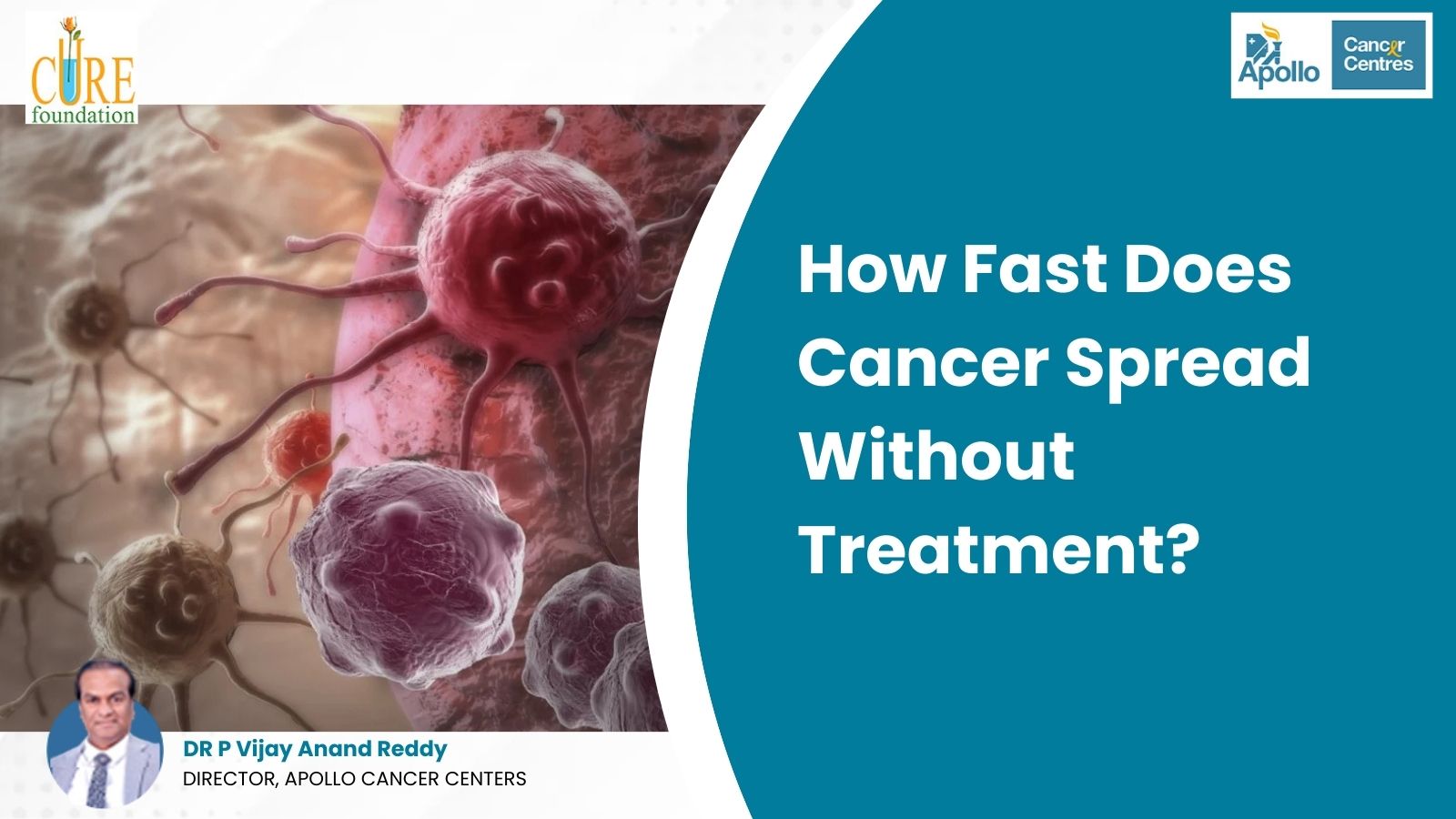 How Fast Does Cancer Spread Without Treatment?