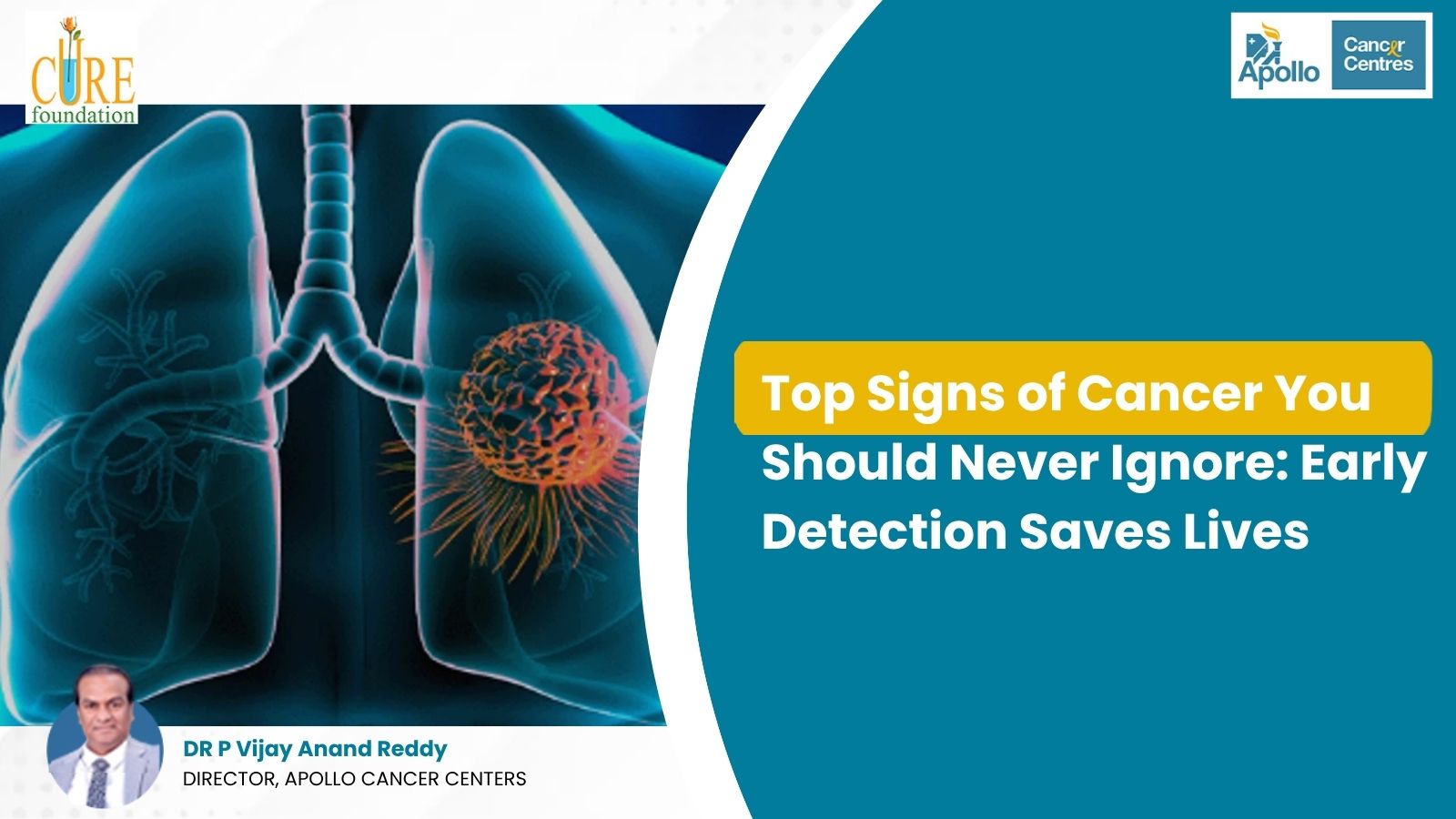 Top Signs of Cancer You Should Never Ignore: Early Detection Saves Lives