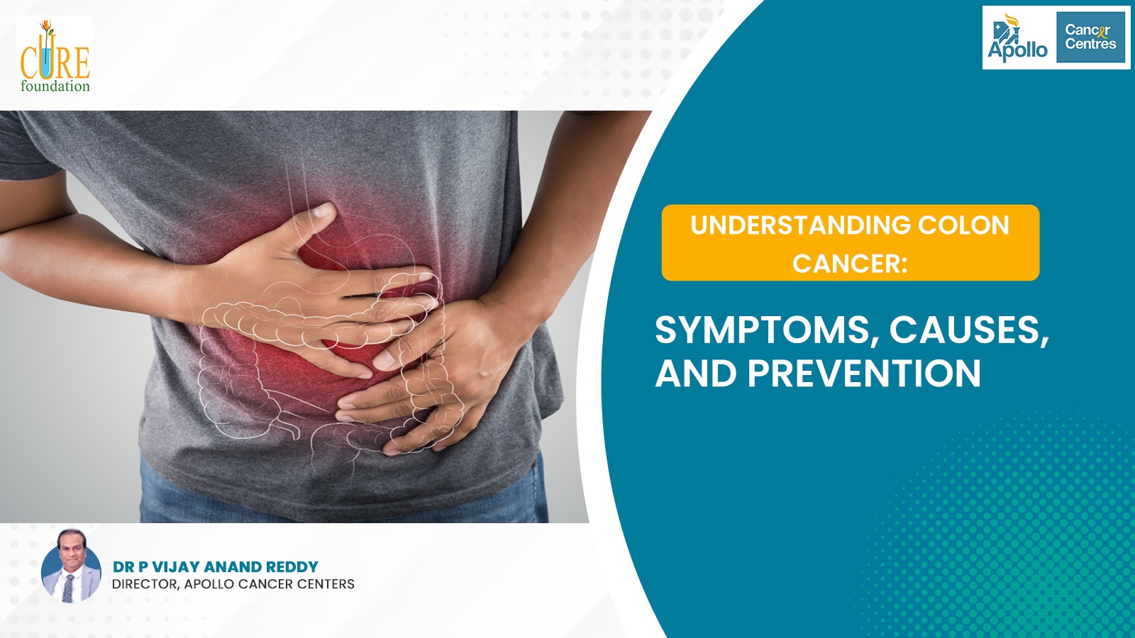 Understanding Colon Cancer: Symptoms, Causes, and Prevention