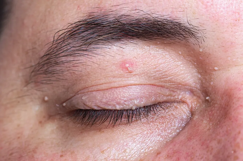 Eyelid Cancer Treatment in India