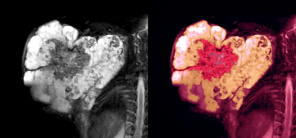 Soft Tissue Sarcoma Treatment in India