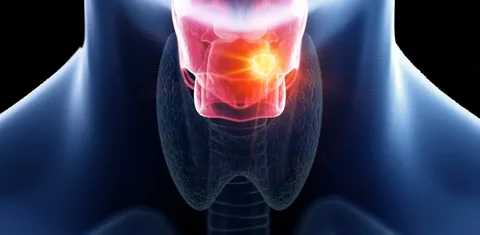 Throat Cancer